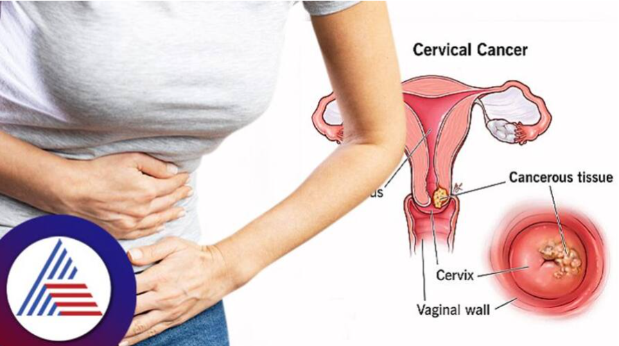 Steps for women to reduce risk of cervical cancer